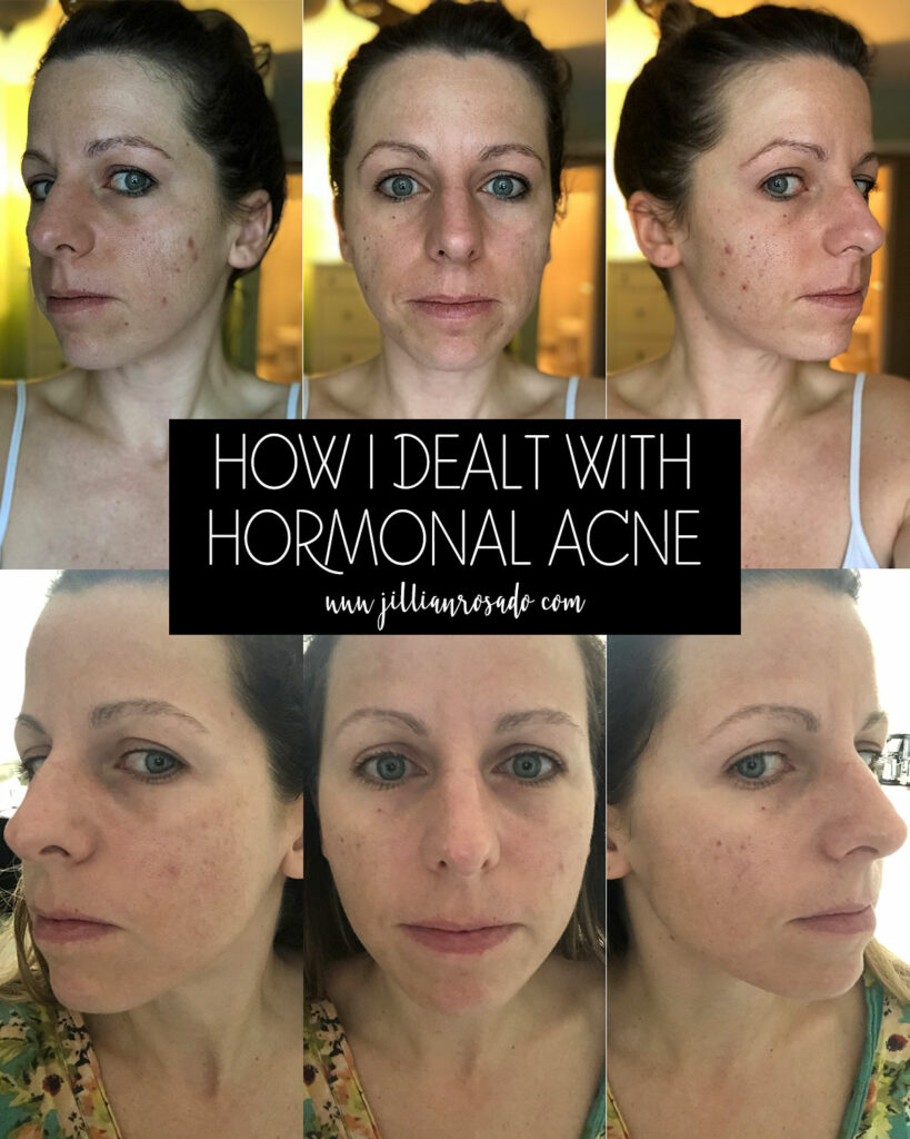 Skincare Routine Hormonal Acne